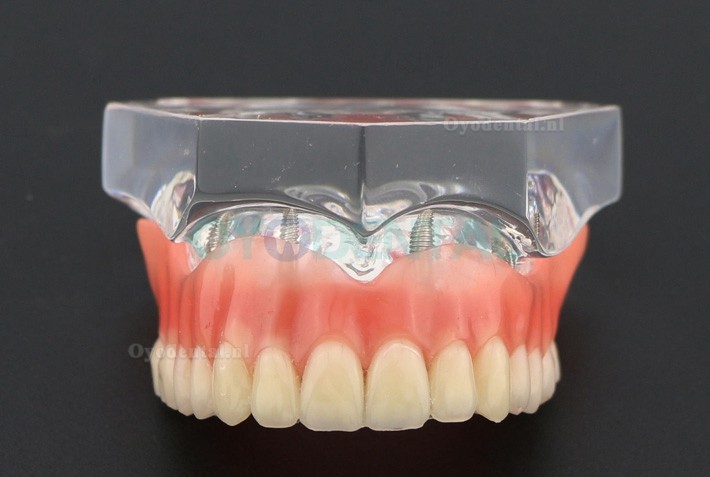 Tandheelkundige studie Tanden Model Overdenture met 4 implantaten Demo Model 6001